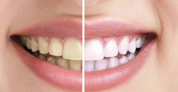 Memutihkan Gigi Kuning Secara Alami dengan Cara Aman dan Mudah